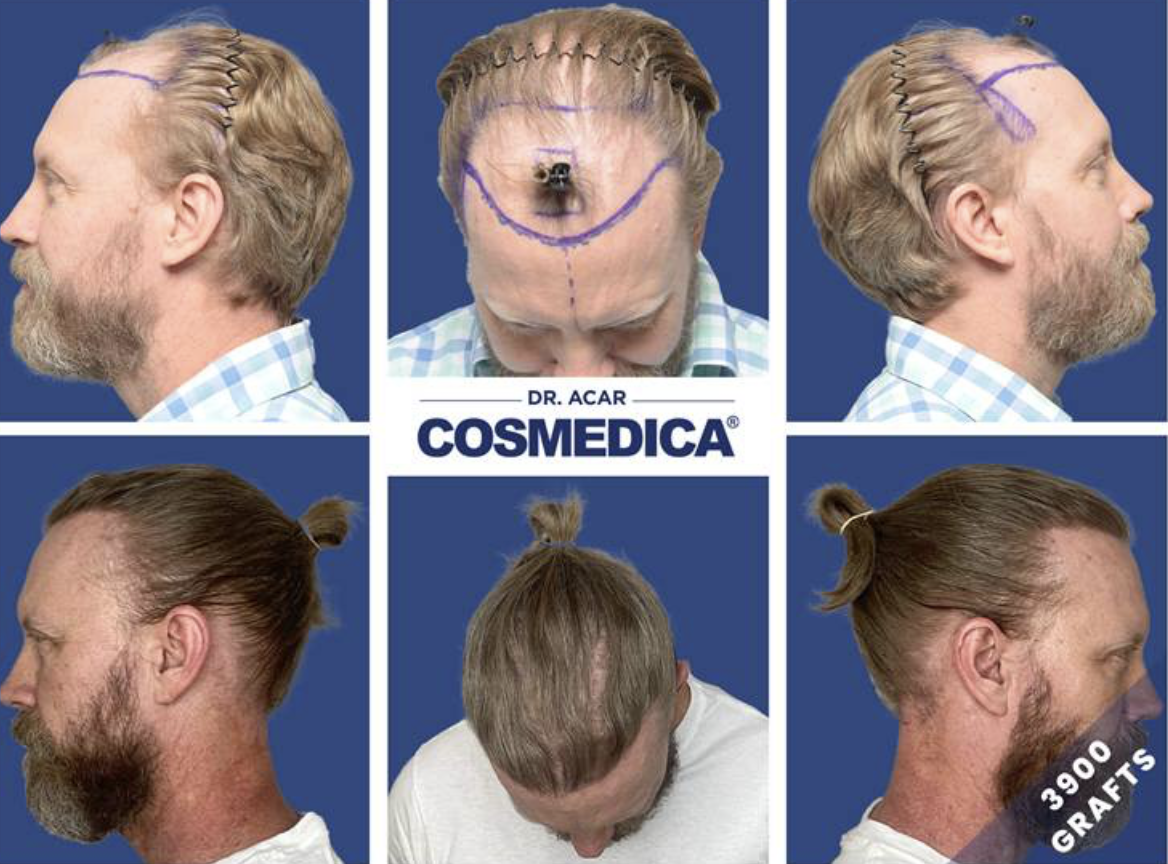 Hair Transplant in Turkey: Clinics, Costs, and Success Stories