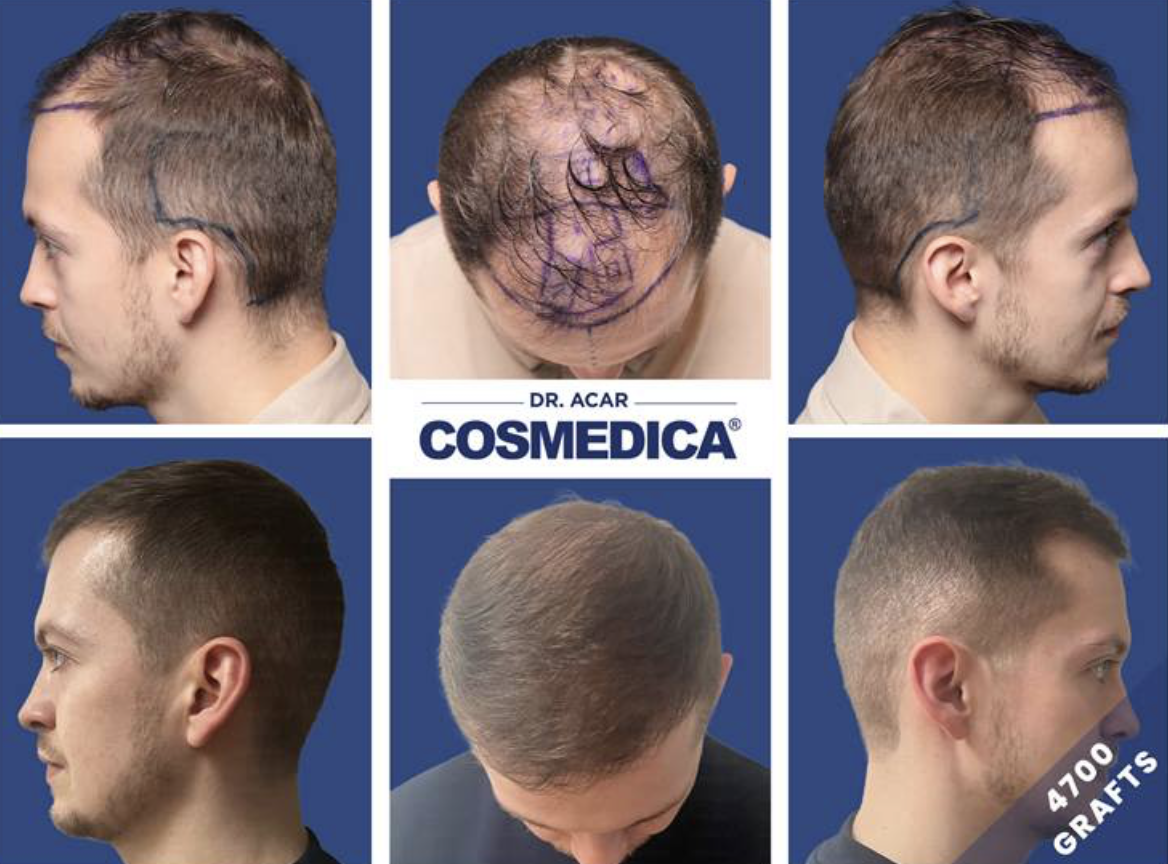 Hair Transplant in Turkey: Clinics, Costs, and Success Stories
